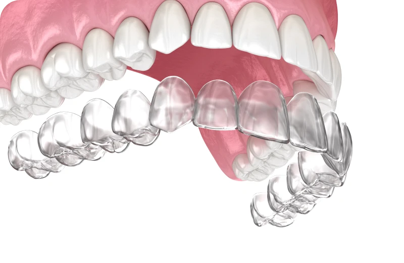 contention nocturne punaauia port contention nocturne punaauia port Tahiti orthodontie Dr Isabelle Chartres, Orthodontiste Tahiti