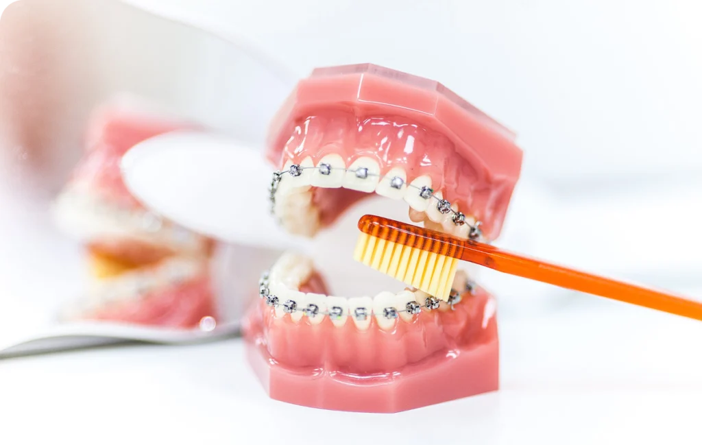 hygiene bucco dentaire punaauia appareil hygiene bucco dentaire punaauia appareil Appareil dentaire Dr Isabelle Chartres, Orthodontiste Tahiti