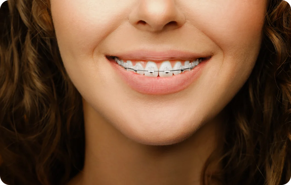 hygiene bucco dentaire punaauia bagues hygiene bucco dentaire punaauia bagues Appareil dentaire Dr Isabelle Chartres, Orthodontiste Tahiti