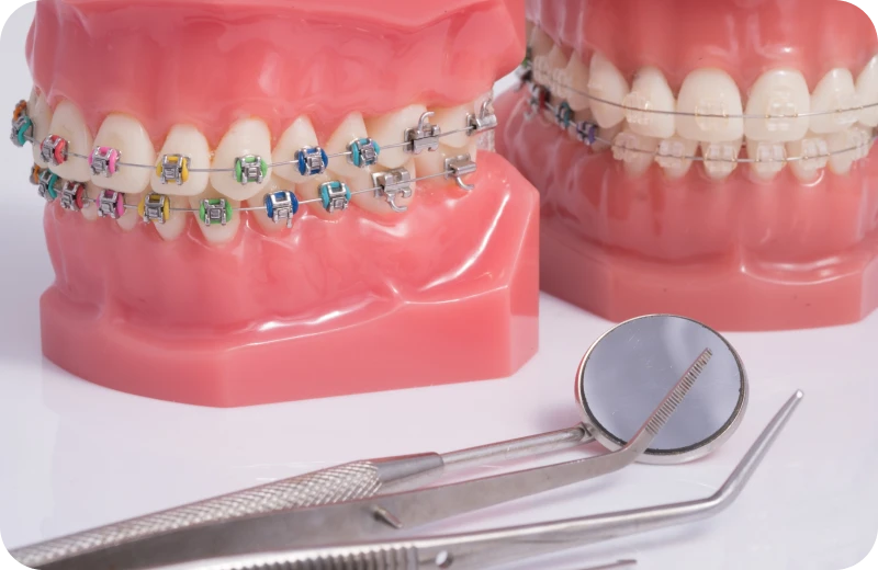 multi bagues punaauia multi bagues punaauia Tahiti orthodontie Dr Isabelle Chartres, Orthodontiste Tahiti